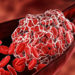 Blood Clot