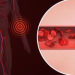 Picture showing peripheral pain from a narrow artery